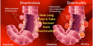 How Long Does it Take to Recover from Diverticulitis