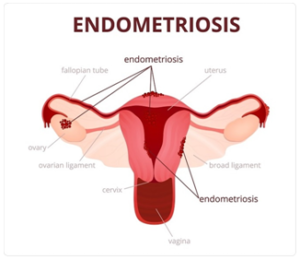 treatment for endometriosis UK